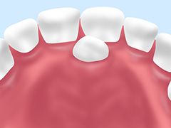 余分な歯の抜歯
