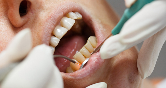 進行段階に応じた様々な歯周病治療を提供しています