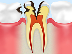 C3 神経に達した虫歯