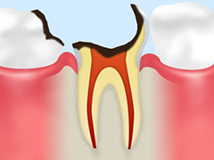 C4 歯根に達した虫歯